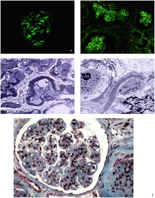 C3 glomerulopathies: dense deposit disease and C3 glomerulonephritis